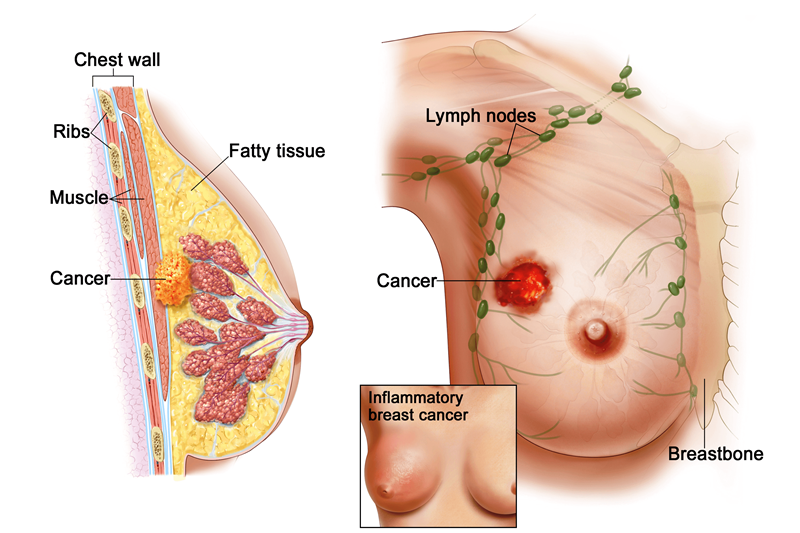 Triệu chứng xuất hiện phổ biến trong ung thư vú